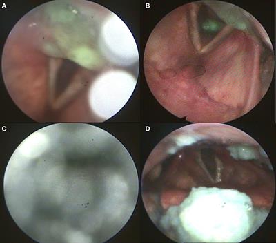 Dysphagia as Isolated Manifestation of Jo-1 Associated Myositis?